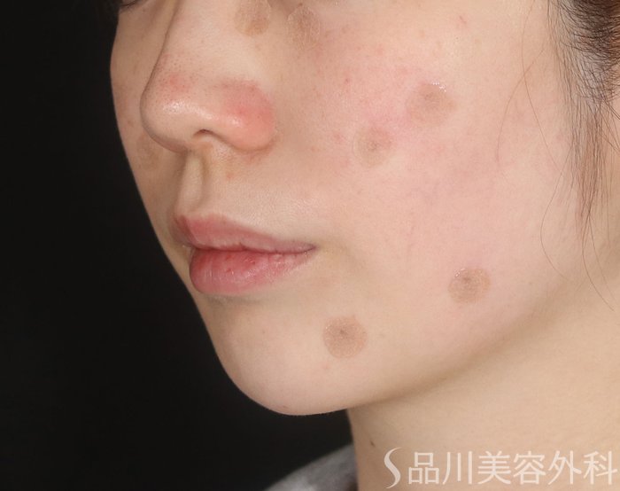 症例NO.73199のAFTER写真