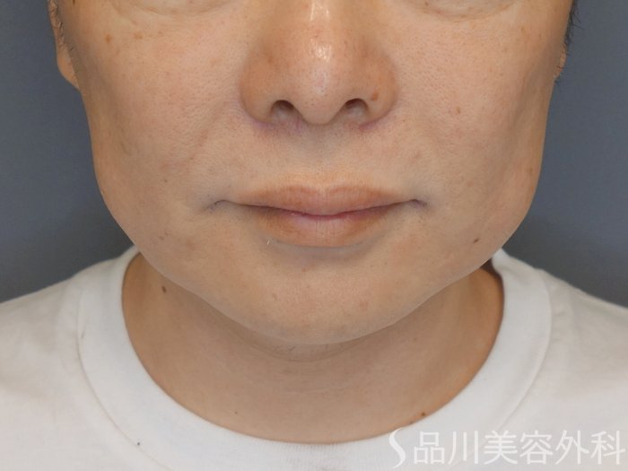 症例NO.70338のBEFORE写真