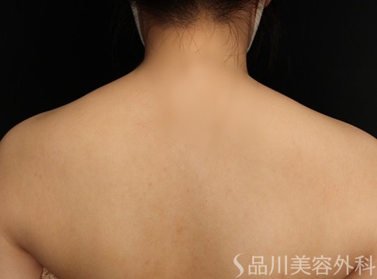 症例NO.71184のBEFORE写真