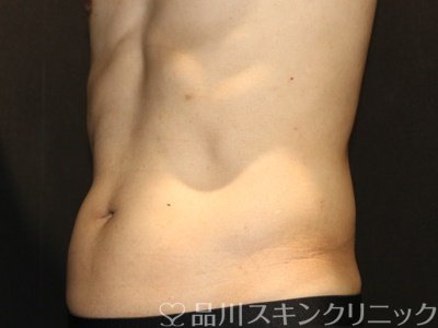 症例NO.74391のAFTER写真