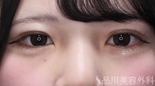 症例NO.73617のAFTER写真