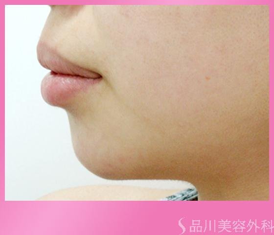 症例NO.1144のBEFORE写真