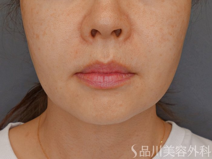 症例NO.71323のBEFORE写真