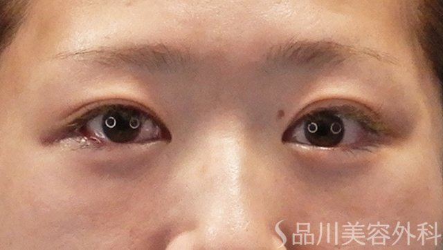 症例NO.73798のAFTER写真