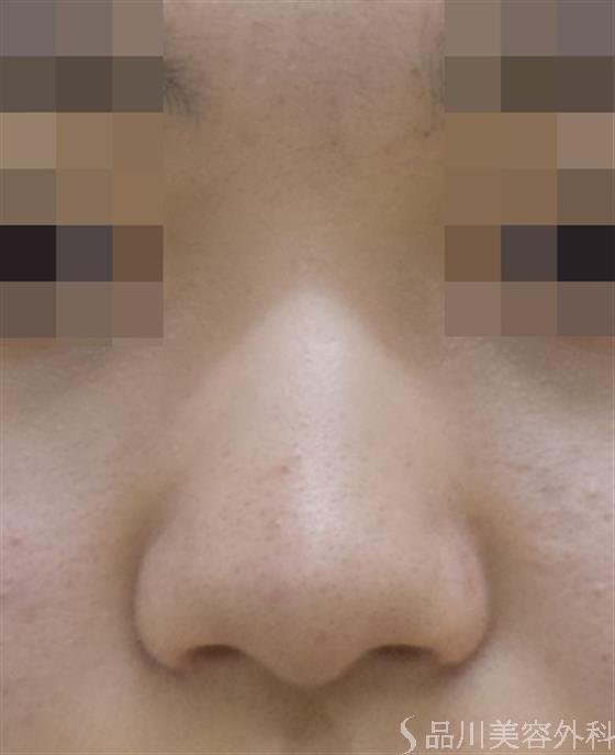 症例NO.47154のBEFORE写真