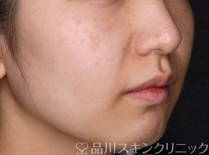 症例NO.69390のBEFORE写真