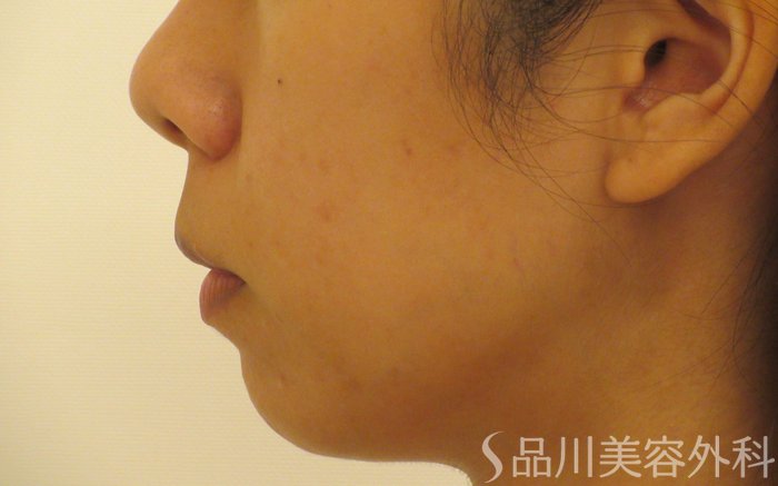 症例NO.71466のBEFORE写真