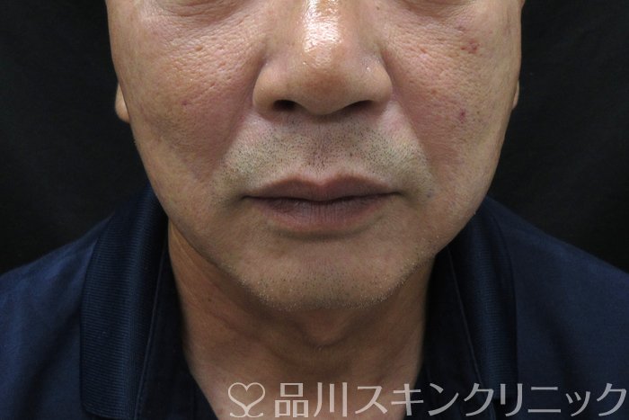 症例NO.74653のAFTER写真
