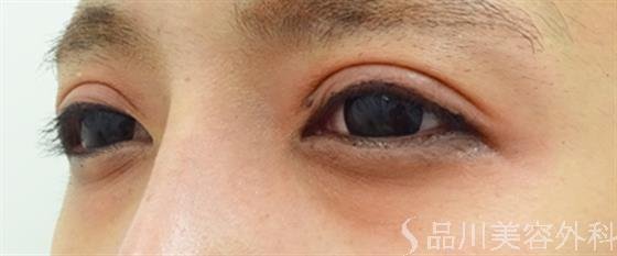 症例NO.45339のAFTER写真