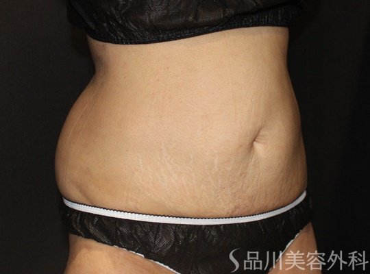 症例NO.71927のAFTER写真