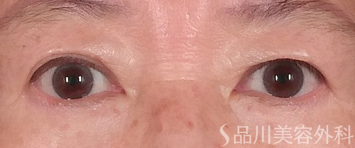症例NO.71179のBEFORE写真