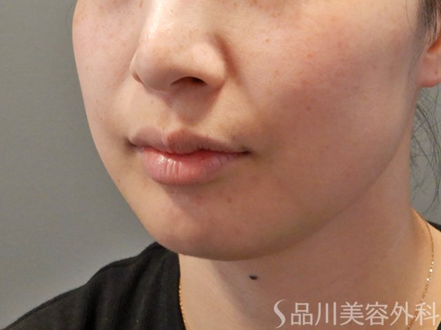 症例NO.74138のBEFORE写真
