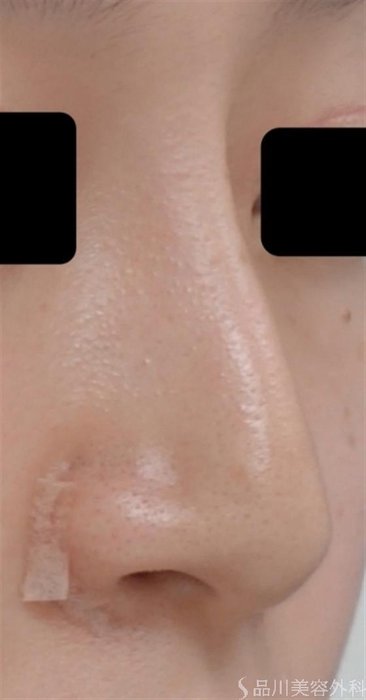症例NO.31844のBEFORE写真