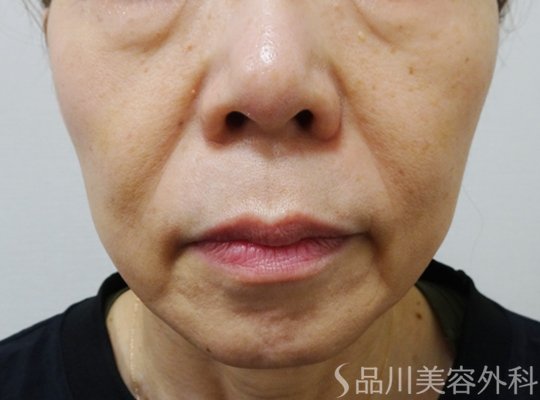 症例NO.69883のBEFORE写真