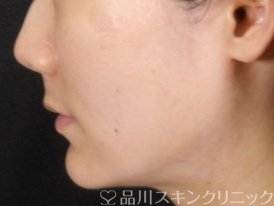症例NO.71655のAFTER写真