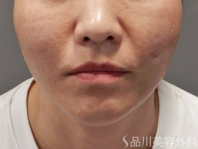 症例NO.71830のAFTER写真