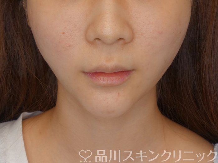 症例NO.71811のAFTER写真