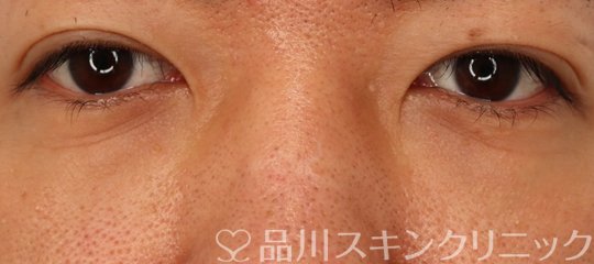 症例NO.72655のAFTER写真