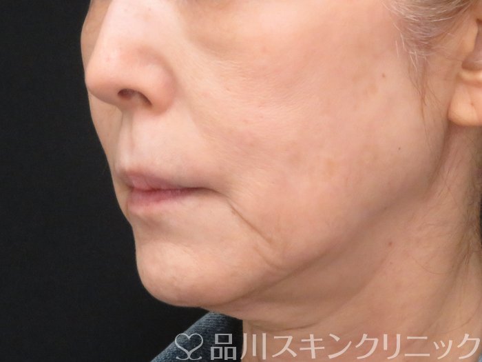 症例NO.69981のBEFORE写真