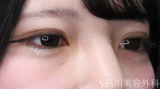 症例NO.73617のAFTER写真