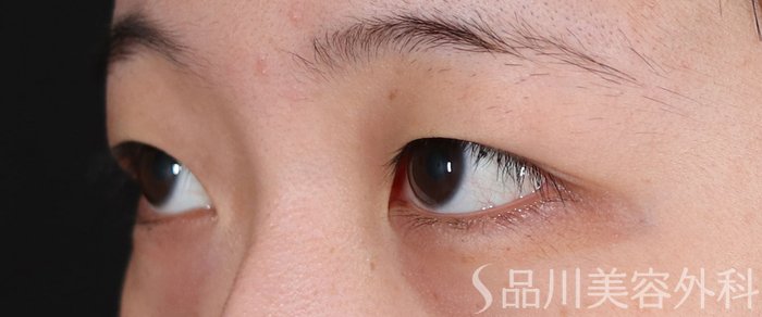 症例NO.71075のBEFORE写真