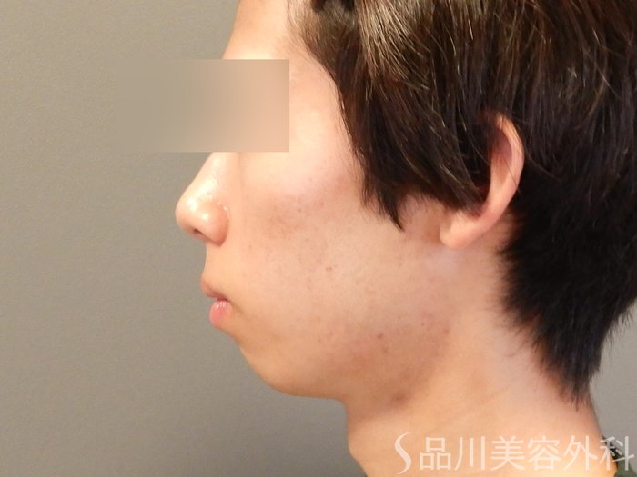 症例NO.65380のAFTER写真