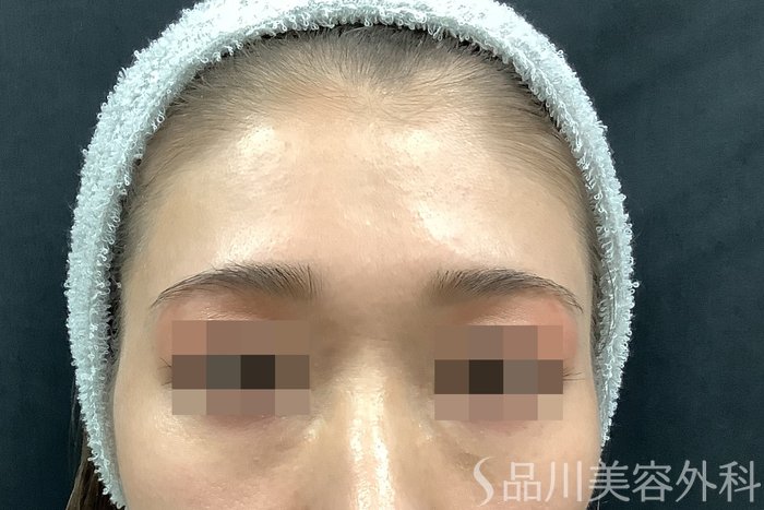 症例NO.63225のBEFORE写真