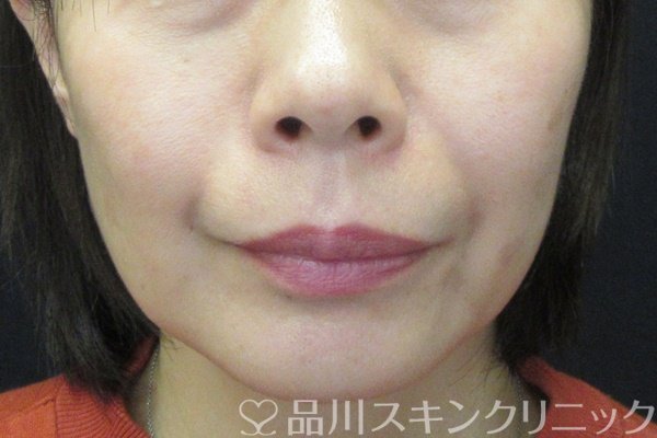 症例NO.67376のBEFORE写真