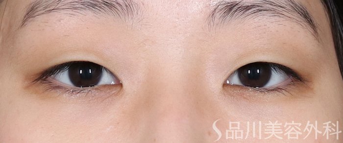 症例NO.71502のBEFORE写真