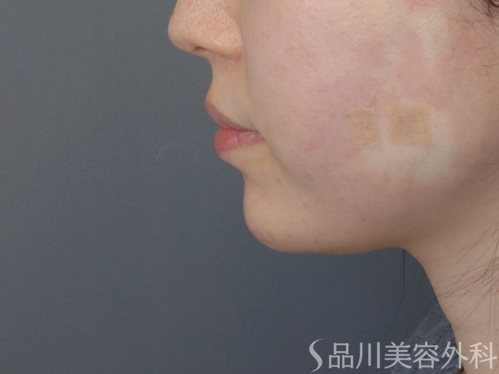 症例NO.72487のAFTER写真