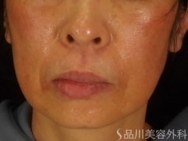 症例NO.72732のBEFORE写真