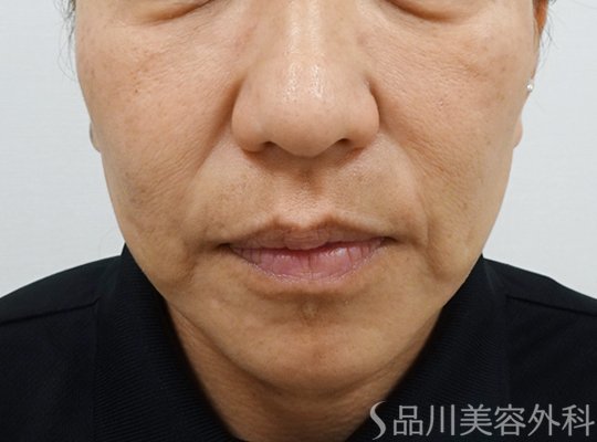 症例NO.72847のBEFORE写真