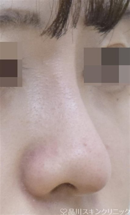 症例NO.54130のAFTER写真
