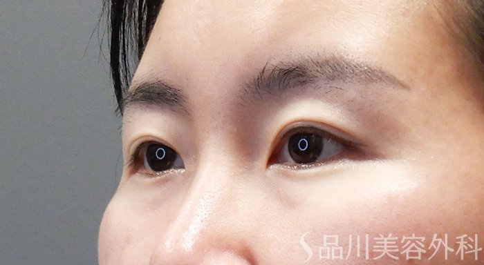 症例NO.69335のBEFORE写真