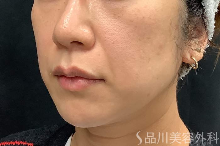 症例NO.73312のBEFORE写真