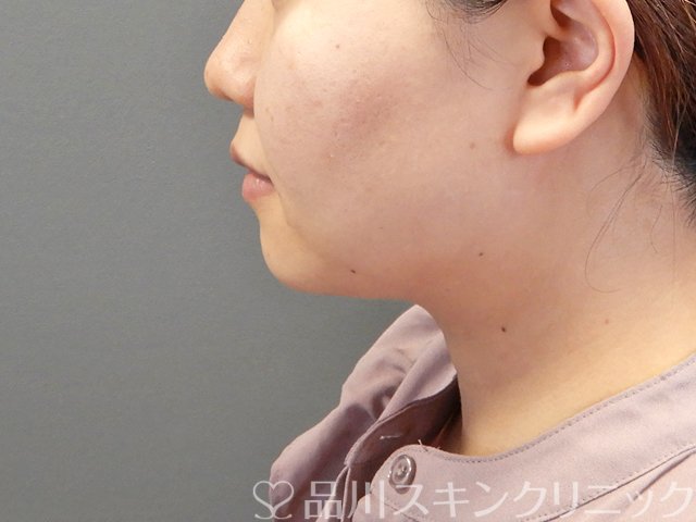 症例NO.63334のBEFORE写真