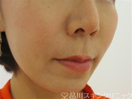 症例NO.33196のAFTER写真