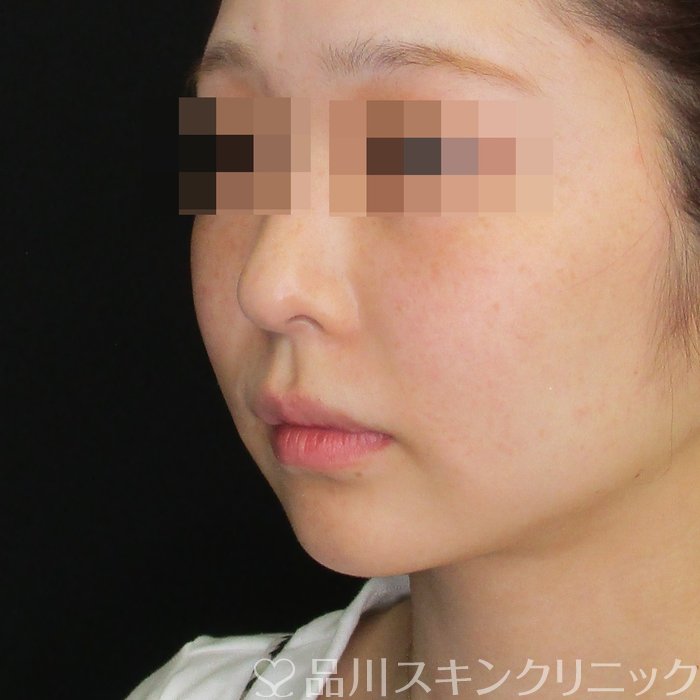 症例NO.75034のBEFORE写真