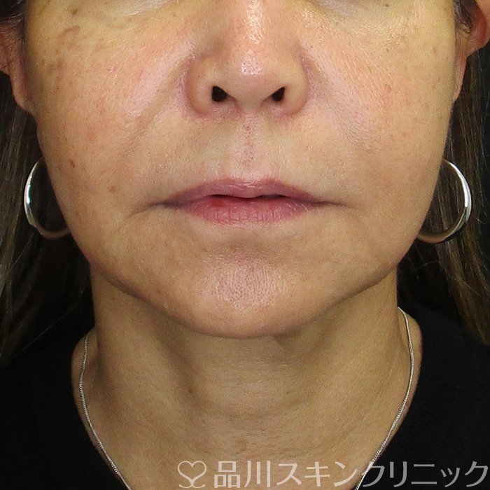 症例NO.74580のBEFORE写真
