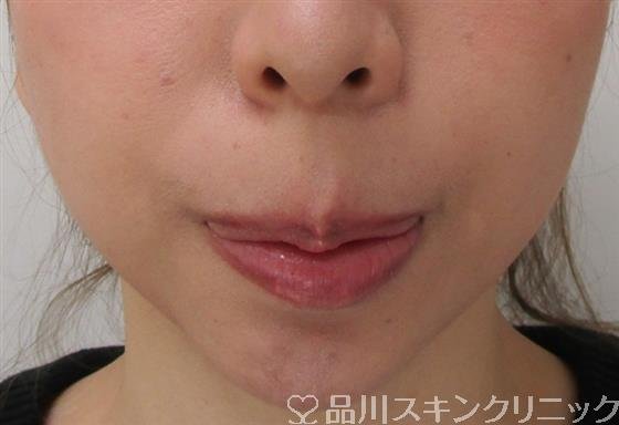 症例NO.39635のAFTER写真