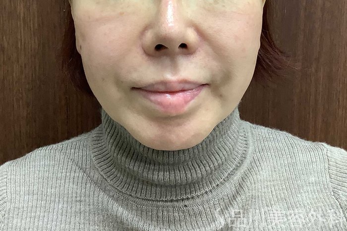 症例NO.71291のBEFORE写真