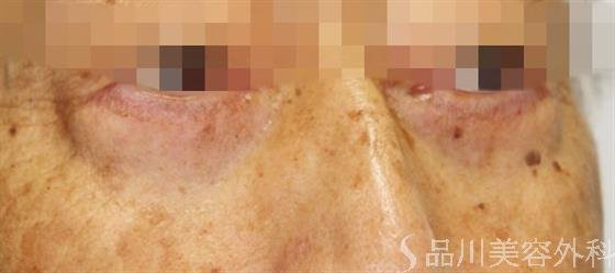 症例NO.53547のAFTER写真