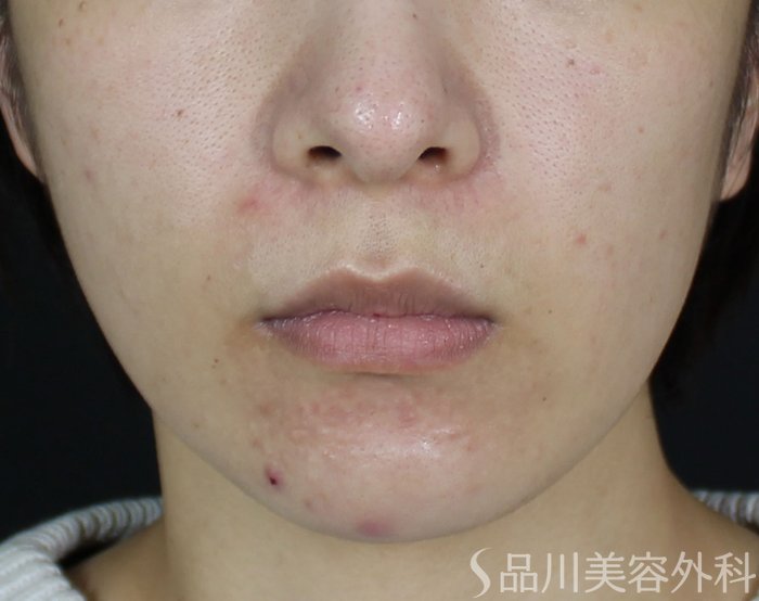 症例NO.70496のBEFORE写真