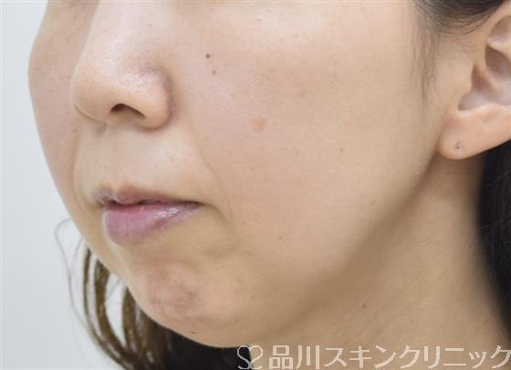 症例NO.43230のBEFORE写真