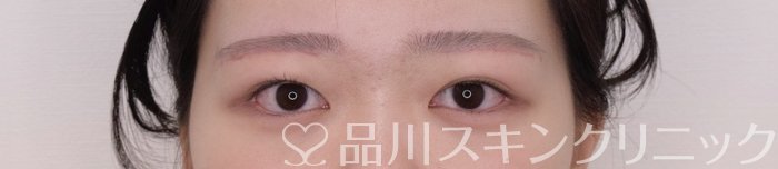 症例NO.69372のAFTER写真