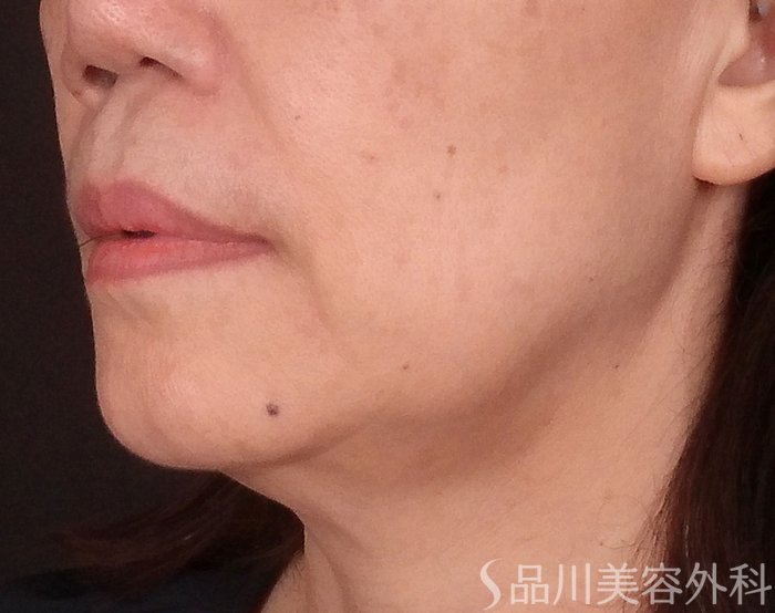 症例NO.70534のBEFORE写真