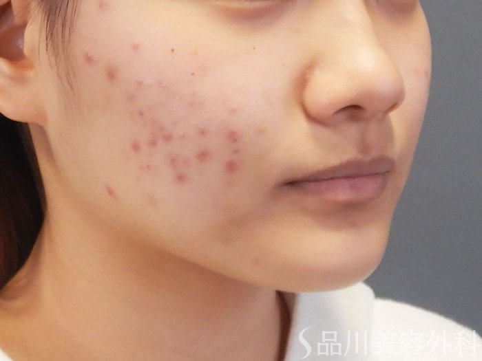 症例NO.72102のBEFORE写真