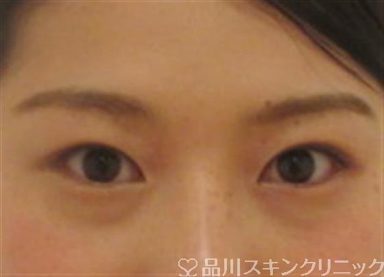 症例NO.36230のAFTER写真