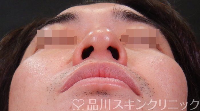 症例NO.65965のBEFORE写真