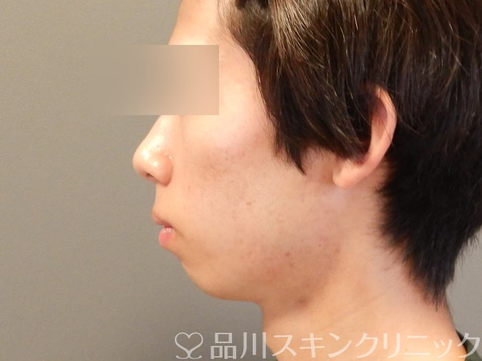 症例NO.65380のAFTER写真